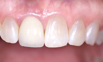 Closeup of teeth and gums after surgery