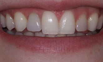 Closeup of teeth and gums after surgery