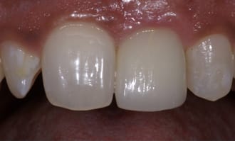 Closeup of teeth and gums after surgery