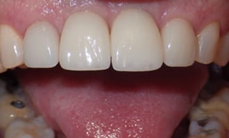 Front teeth implamts look good