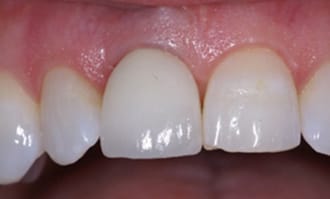 Closeup of teeth and gums after surgery