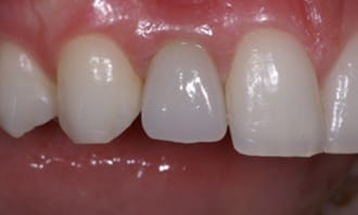 Closeup of teeth and gums after surgery