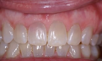 Closeup of teeth and gums before surgery