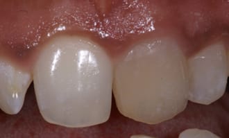 Closeup of teeth and gums before surgery