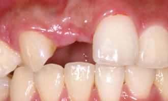 Closeup of missing front tooth before surgery