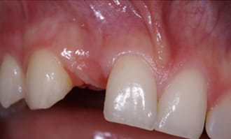 Closeup of teeth and gums before surgery