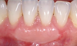 Closeup of teeth and gums after surgery