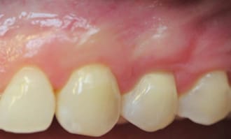 Closeup of teeth and gums after surgery