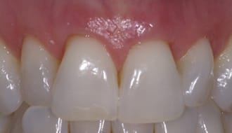Closeup of front teeth and gums after surgery