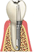 Drawing of a dental implant