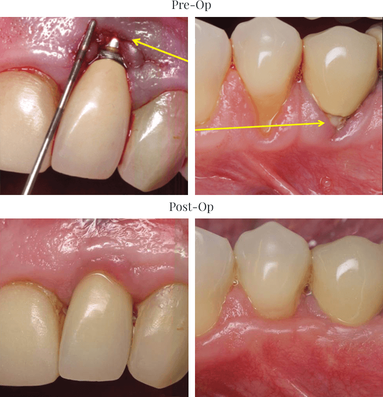 Pre-op and Post-op comparison of masking recession