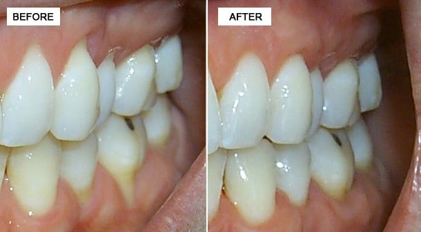 Before after comparison of soft tissue grafting